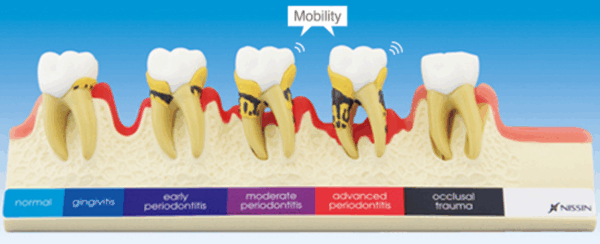 PERIODONTAL DISEASE MODEL [PE-PER010] – Dental Nexus