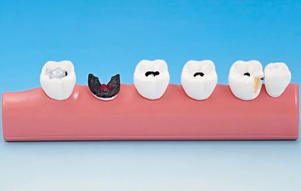 PATIENT EDUCATION MODEL [PE-TDS005] – Dental Nexus